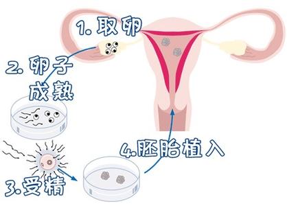 第三代试管婴儿 PGT